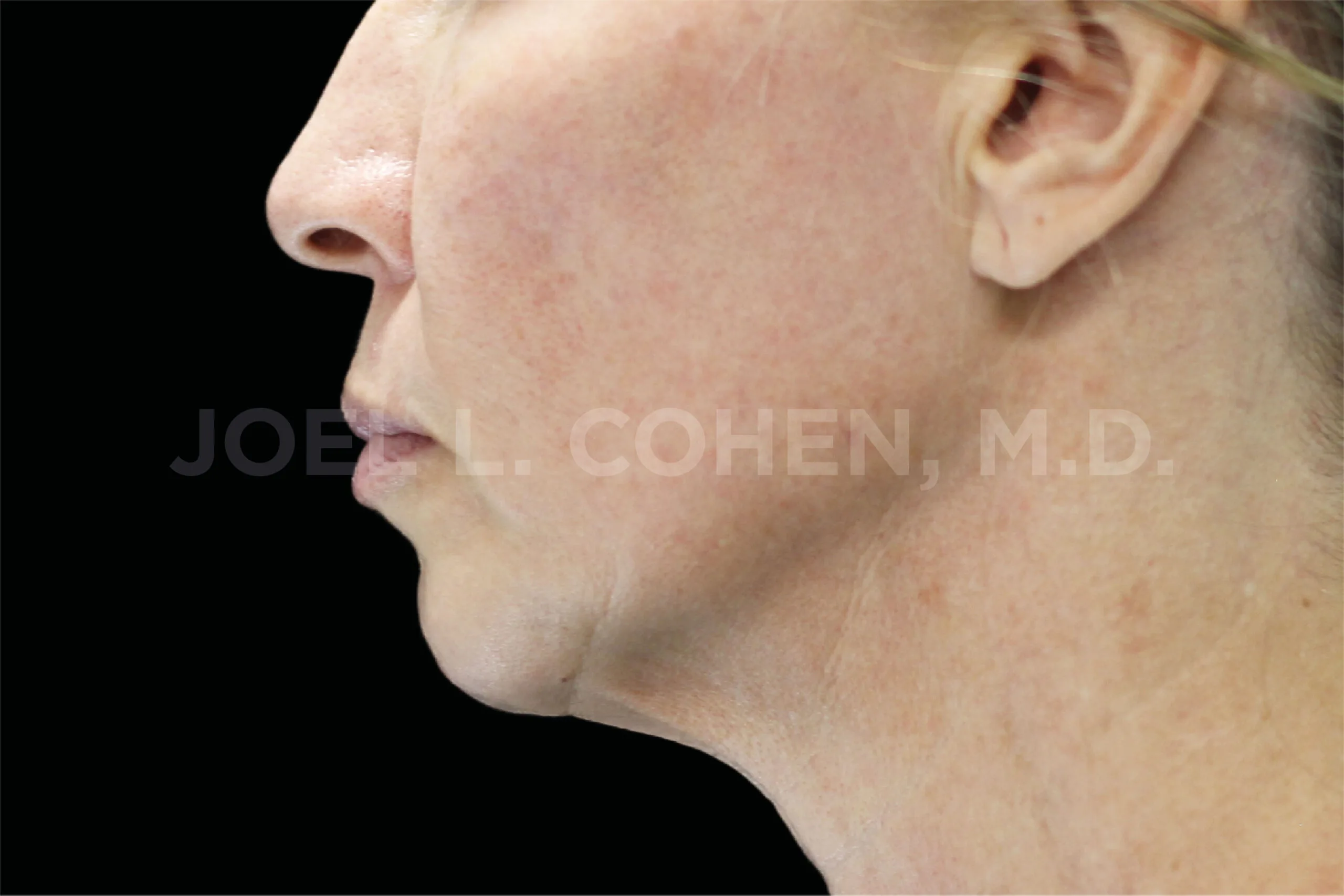 After EMface Submentum